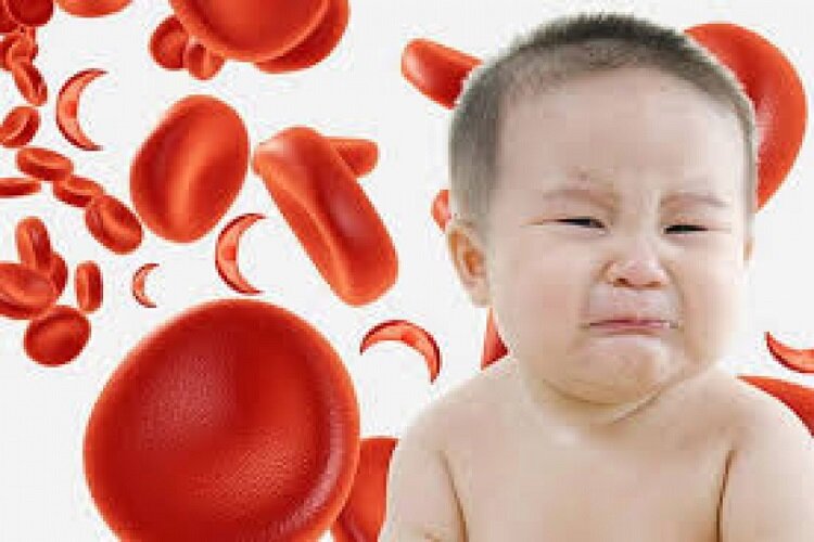 کودک | کودکان عوارض کم خونیهای بینشانه در کودکان چیست؟