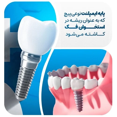 فیکسچر ایمپلنت، جایگزین ریشه طبیعی دندان است.