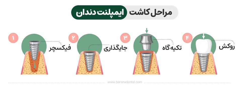 مراحل کاشت ایمپلنت دندان
